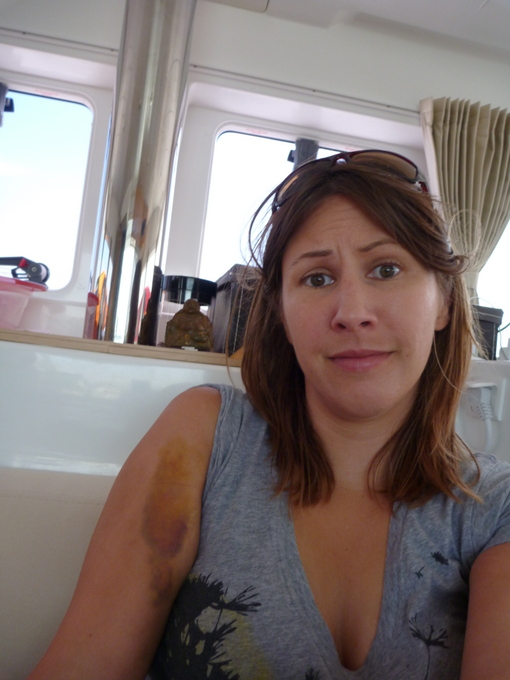 Yeah that's a big bruise. :(